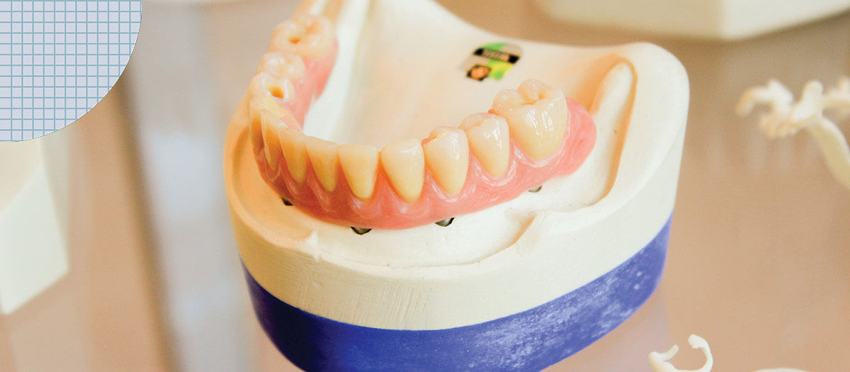 False teeth for implants