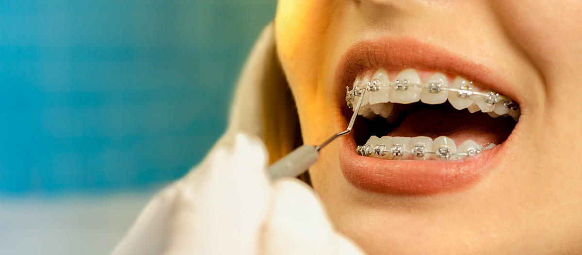 FAQs Mouth with braces